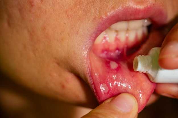 Как избавиться от воспаления под языком?